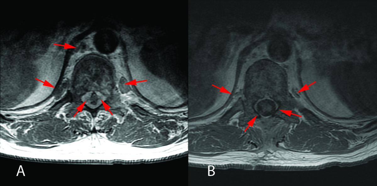 Magnetic resonance imaging (MRI) of the spine showed epidural/ paraspinal tumor extending from T5 - L5 vertebrae with moderate cord compression at T11 (A, red arrows indicate tumor infiltrate). Repeat MRI two months after starting Imatinib therapy showed near complete regression of the epidural tumor (B).